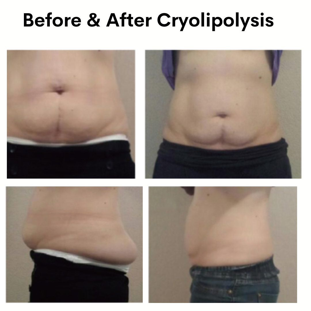 Abdominal Area Before and After Cryolipolysis Treatment
