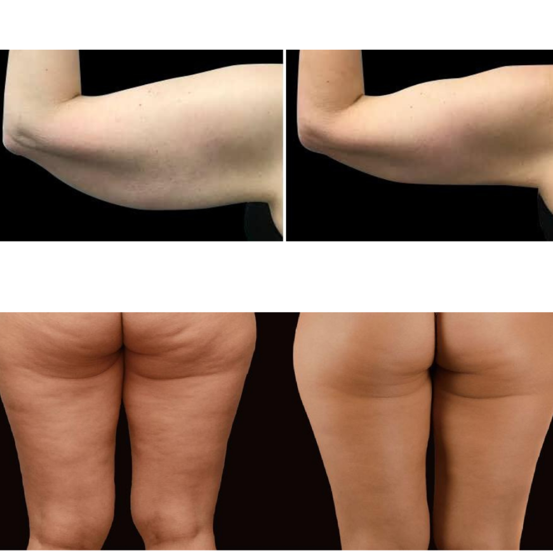 Adonis™ 30K Cavitation Machine Pro 9 in 1