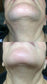 Chin and neck, before and after laser hair removal treatment 