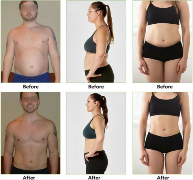 Body of Man and Woman, Before and After Cavitation Lipo Laser Treatments 