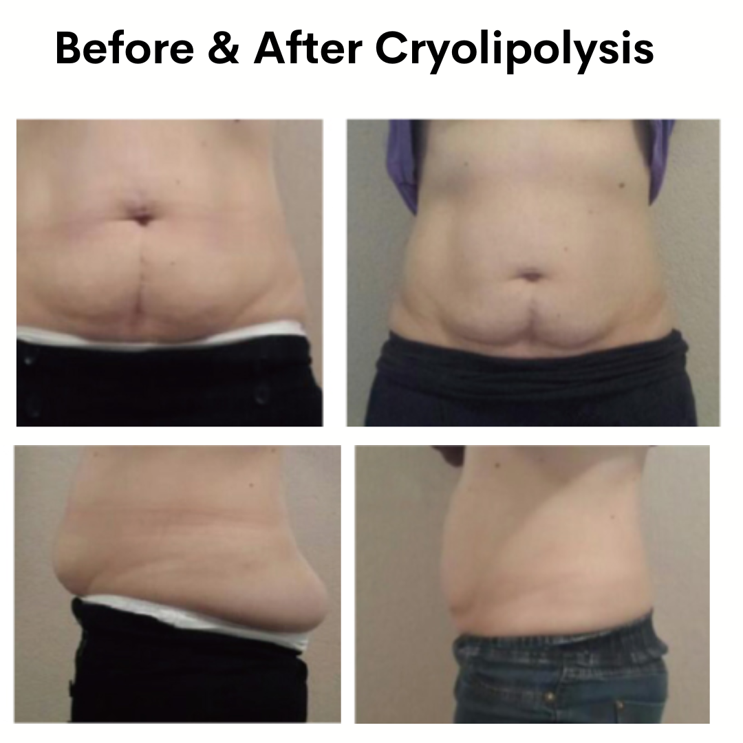 Abdominal Area Before and After Cryolipolysis Treatment 